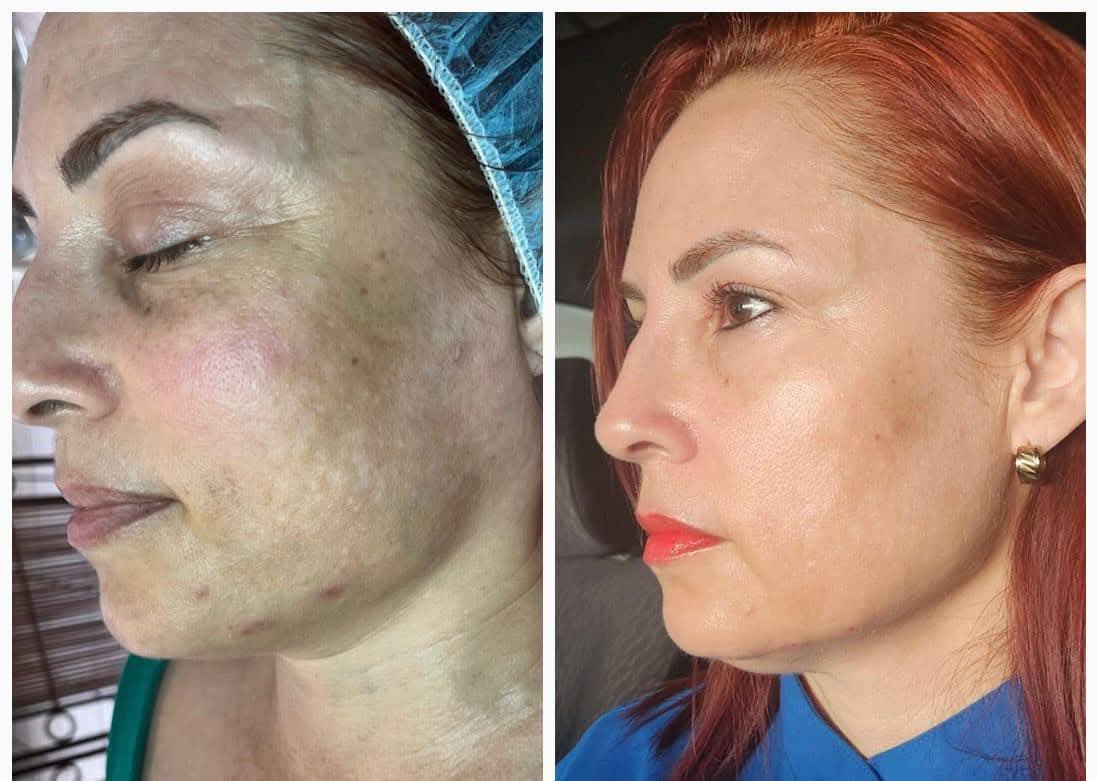 Antes y después tratamiento facial DGBF Esthetic